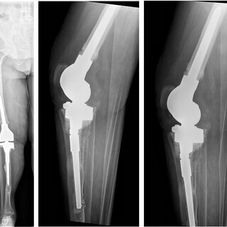 Postoperative-X-ray-of-the-right-knee-joint-in-2016-showing-total-knee-and-distal_Q320